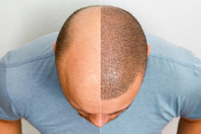 hair transplant in riyadh