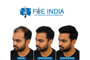 FUE vs FUT: Best Hair Transplant Cost Guide in India