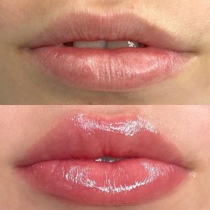 lip injections