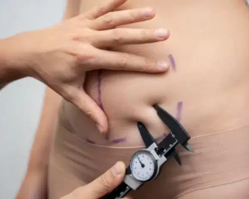 Tummy Tuck Cost in Lahore