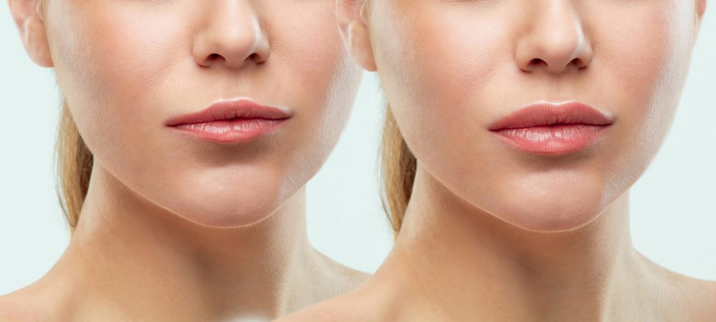 Before and after lip injections. Beauty plastic. Beautiful perfect lips with natural makeup. Sexy macro with female mouth.Plump lips augmentation. Salon procedure