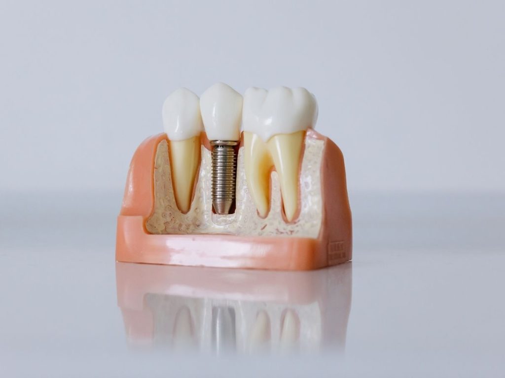 dental implant burbank ca