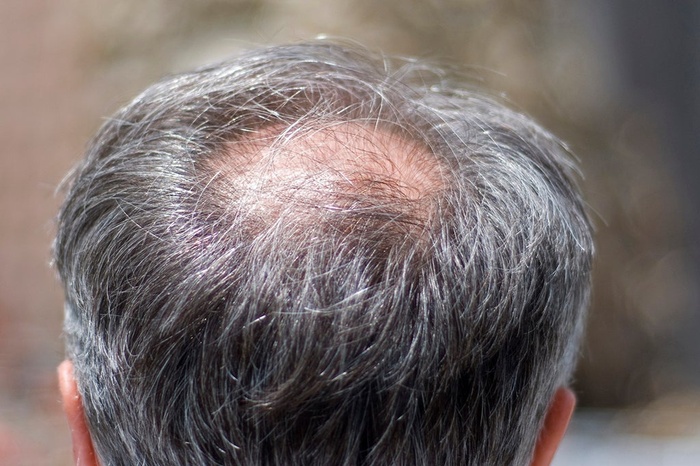 Crown hair transplant