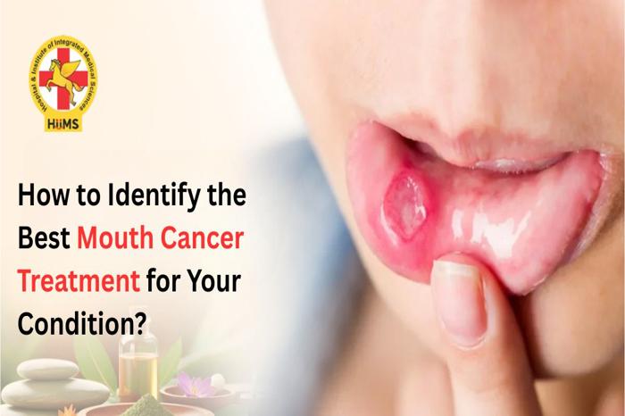 Mouth Cancer Treatment