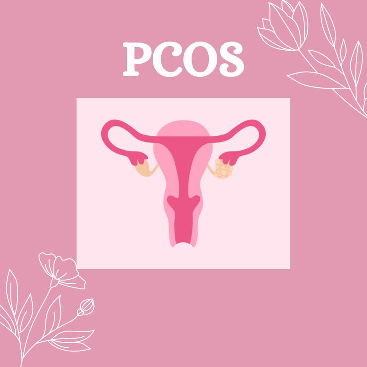 Diet for PCOS
