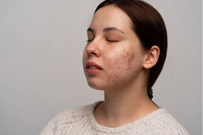 Acne scar