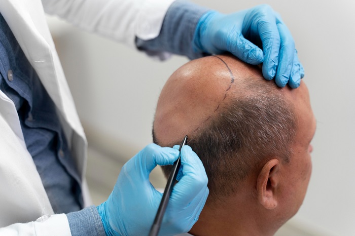 Hair transplant surgery in Islamabad