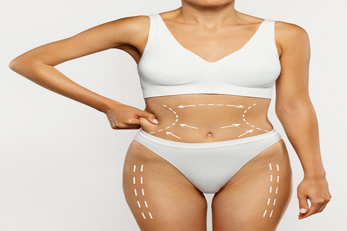 Liposuction in Islamabad