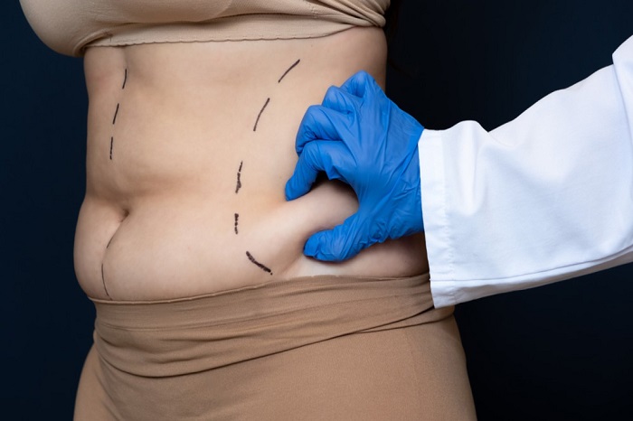 Liposuction in Islamabad