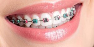 metal braces cost and traditional braces treatment